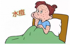 得了水痘怎么办好